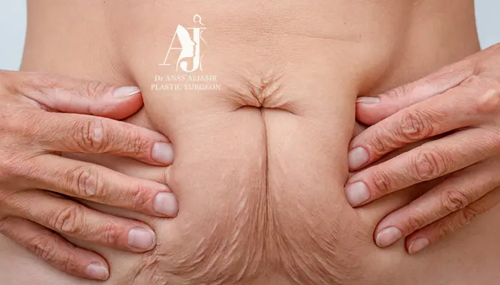 أفضل مركز شد الجسم بعد فقدان الوزن في السعودية