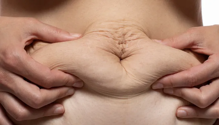 تجربتي مع شد البطن بعد التكميم