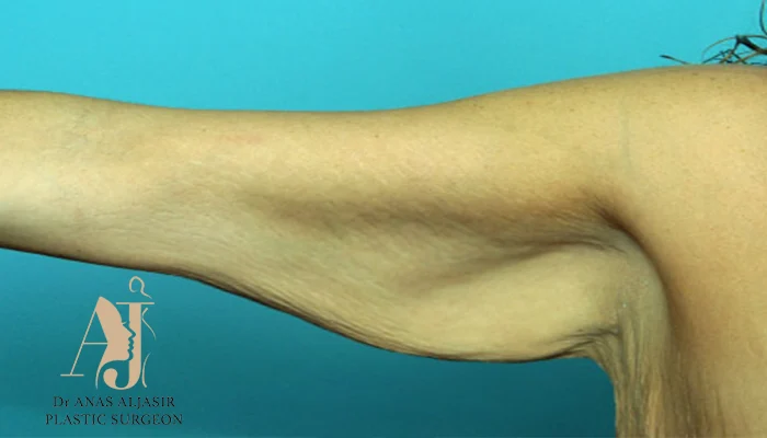 شد الذراعين بعد التخسيس