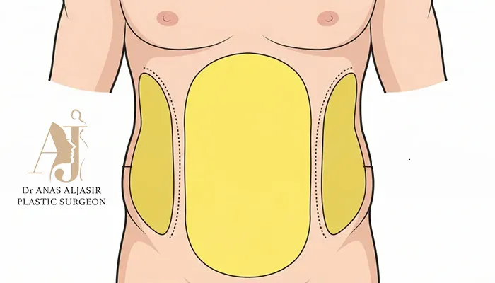 شفط دهون البطن والخواصر