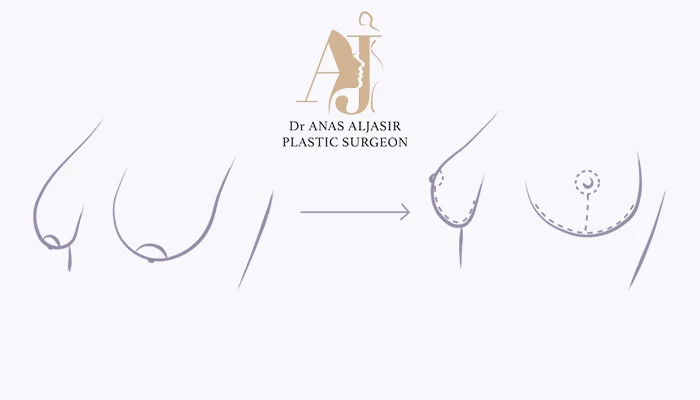 هل يعود ترهل الصدر بعد الشد؟