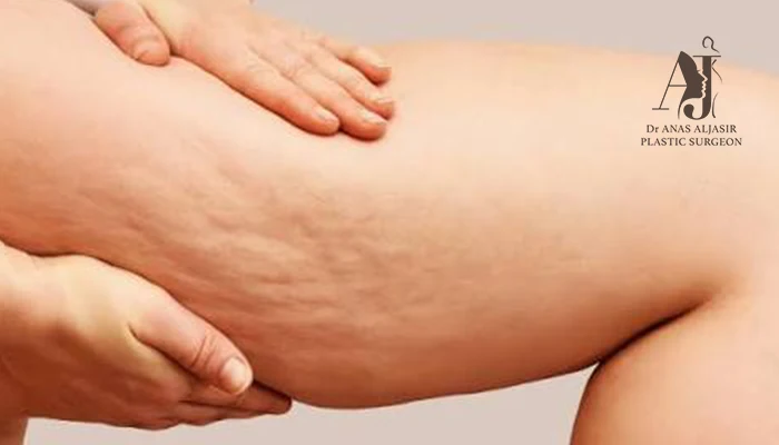 الليبوديمـا (الوذمة الشحمية) Lipedema