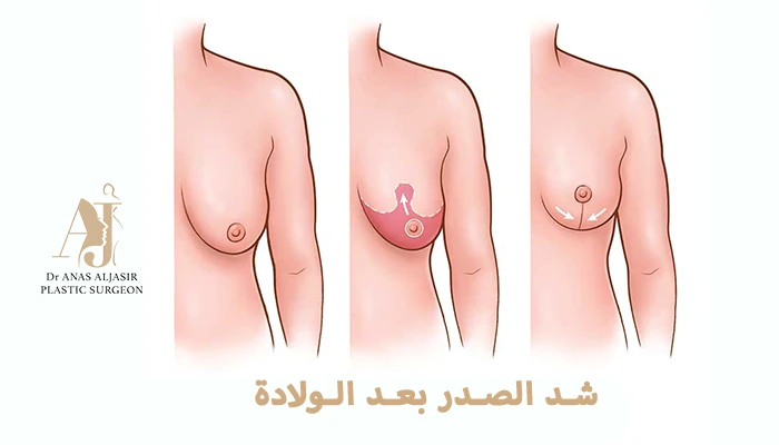 شد الصدر بعد الولادة