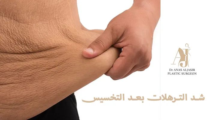 عملية شد الترهلات بعد التخسيس في الرياض