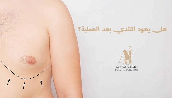 هل يعود التثدي بعد العملية الجراحية؟