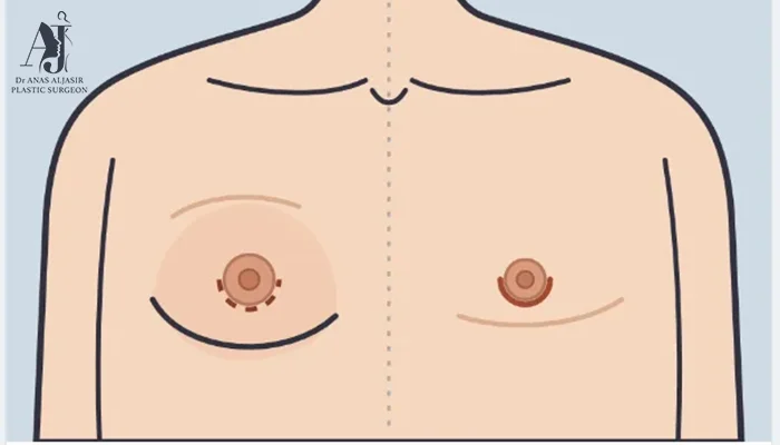 خطوات إزالة التثدي في أفضل مركز تجميل