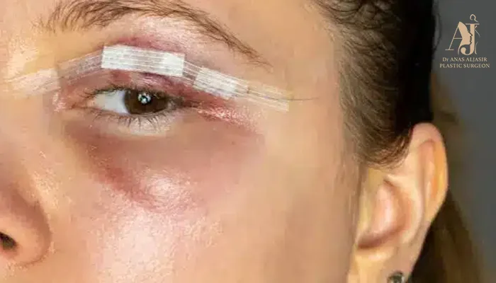 أسباب ظهور أكياس تحت العين بعد عملية شد الجفون