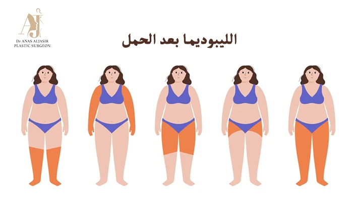 الليبوديما بعد الحمل تغيرات الجسم ومتى ينبغي زيارة طبيب