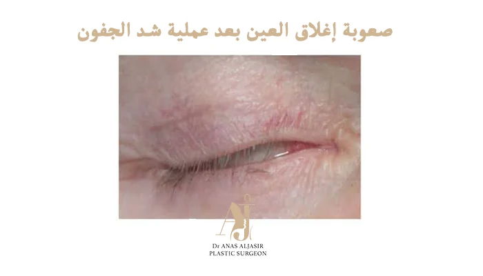 صعوبة إغلاق العين بعد عملية شد الجفون